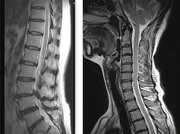 腰椎MRI写真